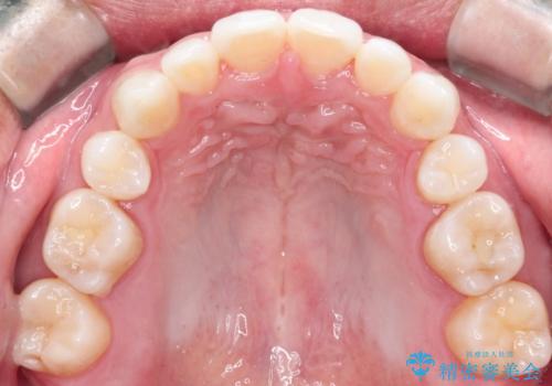 【インビザライン】笑った時の歯並びを綺麗にしたいの治療後