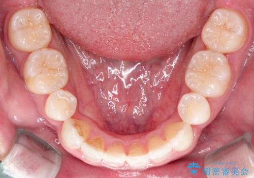 【インビザライン】笑った時の歯並びを綺麗にしたいの治療後