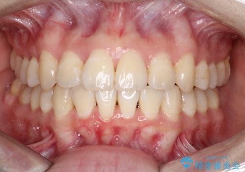 【インビザライン】前歯の凸凹をなおしたいの症例 治療後