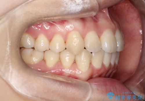 【インビザライン】前歯の凸凹をなおしたいの治療後