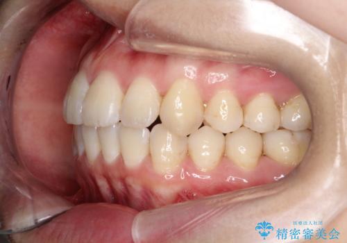 【インビザライン】前歯の凸凹をなおしたいの治療後