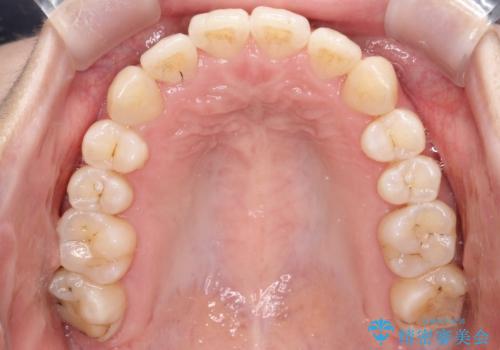 【インビザライン】前歯の凸凹をなおしたいの治療後