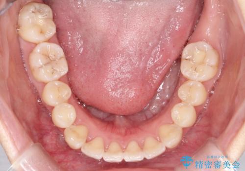 【インビザライン】前歯の凸凹をなおしたいの治療後