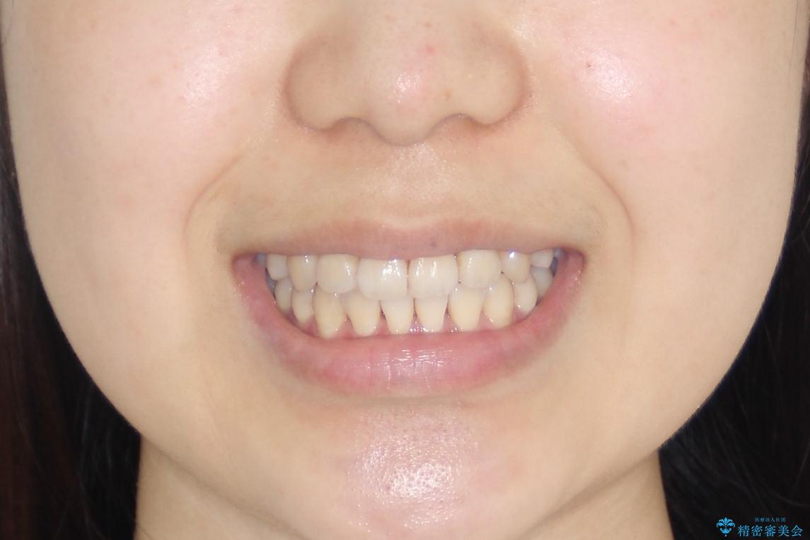 【インビザライン】前歯の凸凹をなおしたいの治療後(顔貌)