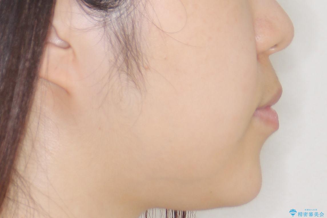 【インビザライン】前歯の凸凹をなおしたいの治療後(顔貌)