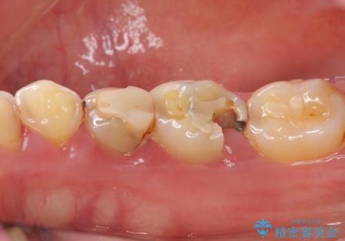 虫歯治療をしたい セラミック治療の症例 治療前
