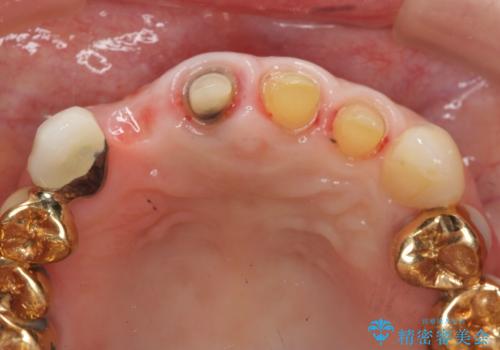 状況に応じた前歯の補綴計画の治療中