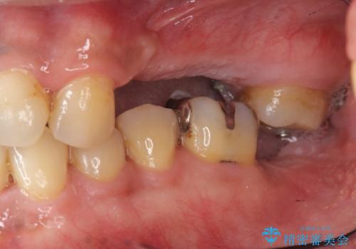咬合平面を揃え、早期接触・干渉を防ぐ補綴治療の治療中