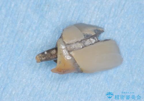 [前歯のグラつき]　根本的な前歯の審美治療を希望