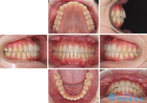 気になる前歯を整えたい インビザライン・ライトでの矯正治療の治療後