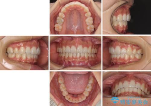 スッキリとした口元へ 出っ歯の抜歯矯正の治療後