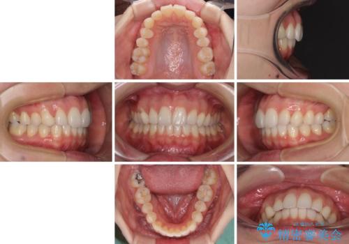 狭い上顎骨を拡大 急速拡大装置を併用したインビザライン矯正の治療後