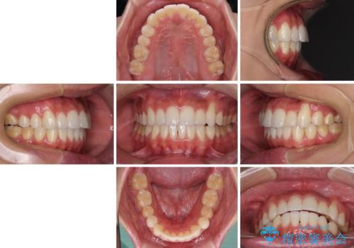 八重歯と奥歯のクロスバイト　上顎骨を拡大してインビザラインで矯正の治療後