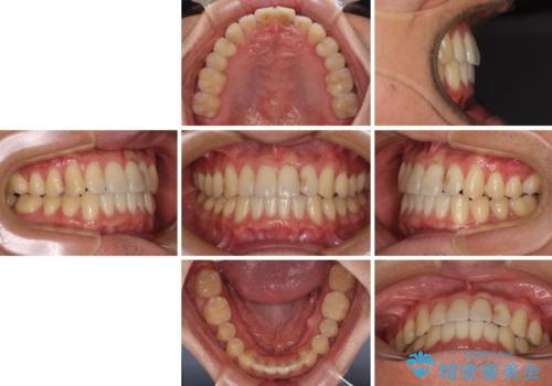 気になる前歯のデコボコをインビザラインで解消の治療後