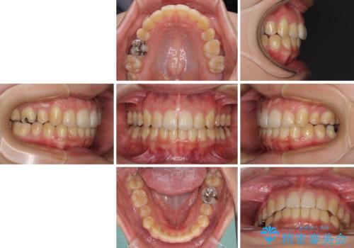 八重歯の抜歯矯正 補助装置を用いたインビザライン矯正の治療後