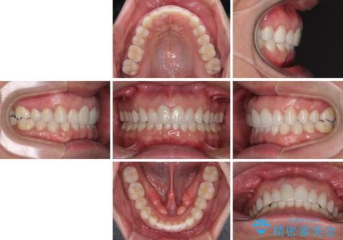 口が閉じにくい インビザラインによる矯正治療の治療後