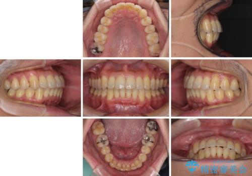 前歯のデコボコ ワイヤー装置での短期間治療の治療後