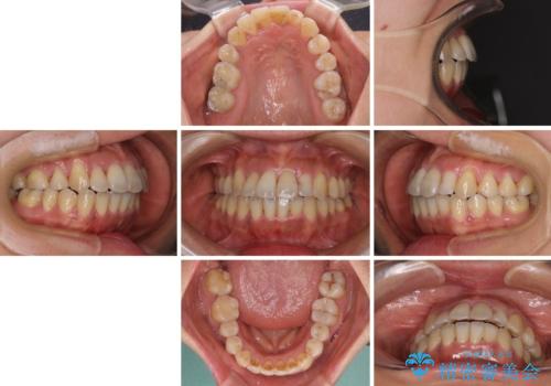 狭い上顎骨を拡大 著しい叢生を抜歯矯正で改善の治療後