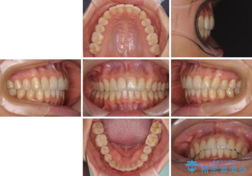 インビザラインによる矯正治療 カリエールディスタライザーを用いた奥歯の咬み合わせ改善の治療後