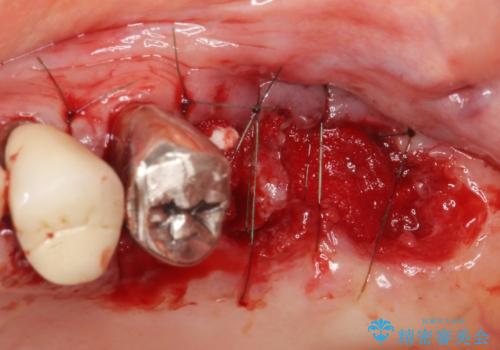 歯ぐきから血が出る、歯ぐきが腫れている 80代女性の治療中