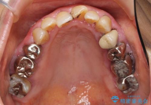 歯ぐきから血が出る、歯ぐきが腫れている 80代女性の治療前