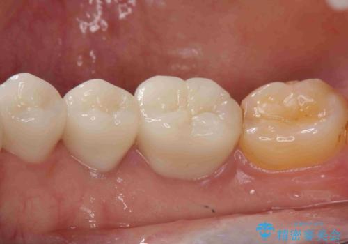 虫歯治療をしたい セラミック治療の症例 治療後