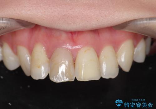 [前歯の変色] 前歯の見た目を改善したいの症例 治療前