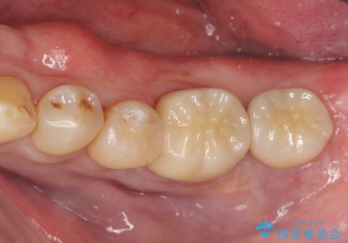 咬合平面を揃え、早期接触・干渉を防ぐ補綴治療の治療後