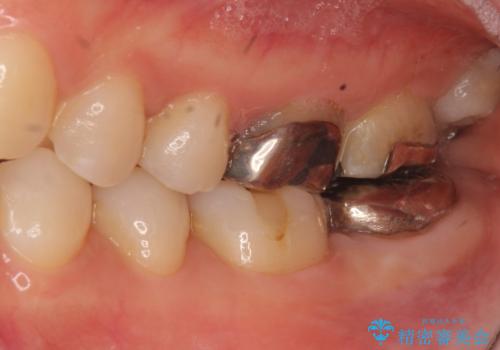 歯が割れた 親知らずの移植 30代女性の治療前