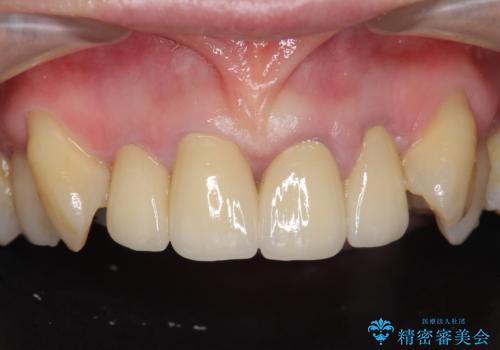 [前歯のグラつき]　根本的な前歯の審美治療を希望の症例 治療後