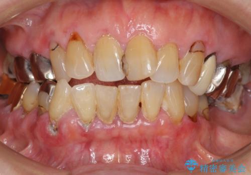 歯ぐきから血が出る、歯ぐきが腫れている　80代女性の症例 治療前
