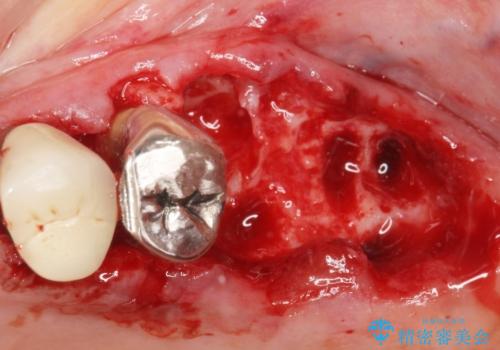 歯ぐきから血が出る、歯ぐきが腫れている 80代女性の治療中