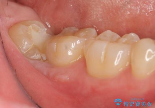 親知らずを起因とする虫歯治療の症例 治療前