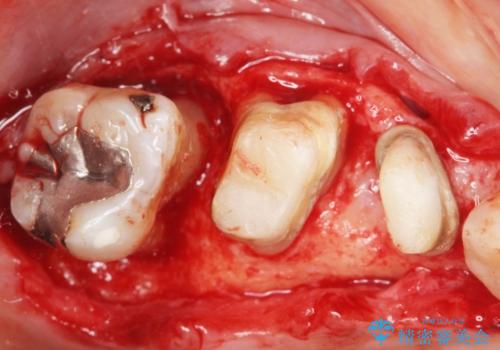 歯ぐきから血が出る、歯ぐきが腫れている 80代女性の治療中