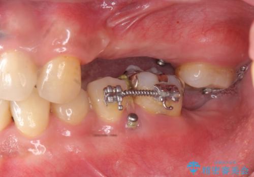 咬合平面を揃え、早期接触・干渉を防ぐ補綴治療の治療中