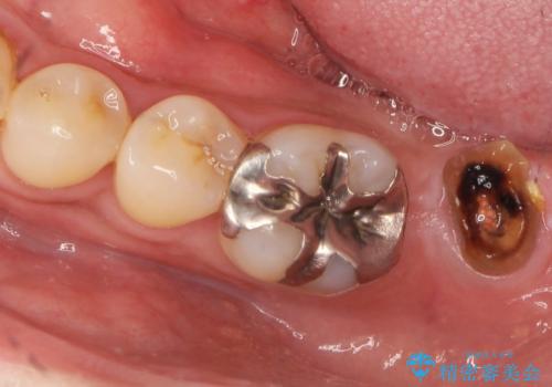 咬合平面を揃え、早期接触・干渉を防ぐ補綴治療の治療前