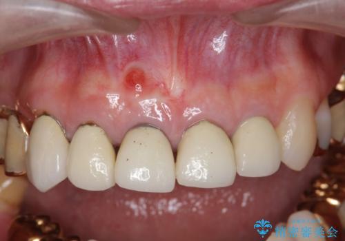 状況に応じた前歯の補綴計画の治療前