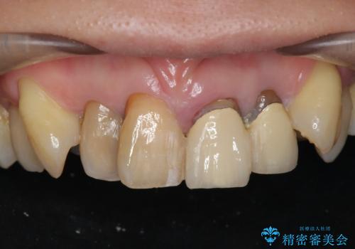 [前歯のグラつき]　根本的な前歯の審美治療を希望の症例 治療前