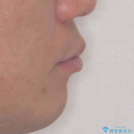 口が閉じにくい インビザラインによる矯正治療の治療前(顔貌)