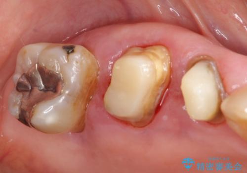 歯ぐきから血が出る、歯ぐきが腫れている 80代女性の治療前