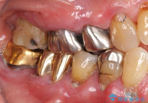 歯ぐきから血が出る、歯ぐきが腫れている 80代女性の治療前