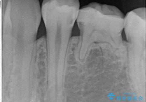 【セラミックインレー】虫歯の治療の治療前