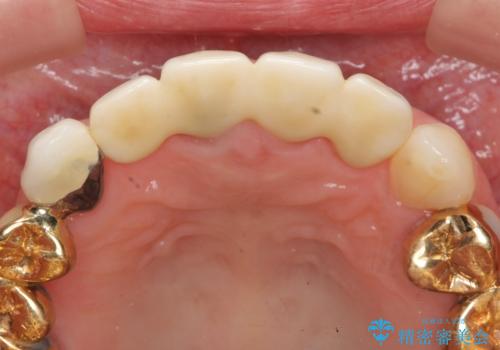 状況に応じた前歯の補綴計画の治療後