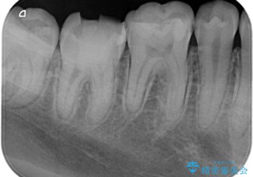 【根管治療】ラバーダムを使用した治療をしてほしいの症例 治療前
