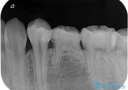 【セラミックインレー】虫歯の治療の治療後