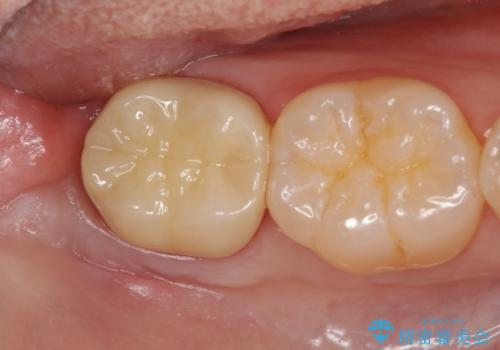 親知らずを起因とする虫歯治療の治療後