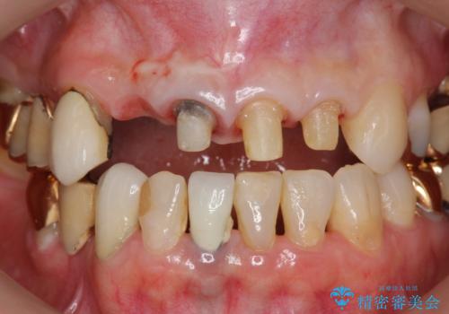 状況に応じた前歯の補綴計画の治療中