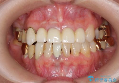 状況に応じた前歯の補綴計画の治療後