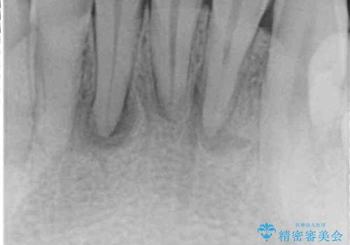 強い咬み合わせで削れた前歯 セラミッククラウンで自然な形にの治療前