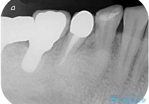 かけて金属の見えてしまったセラミック 強化セラミックでの補綴治療の治療前